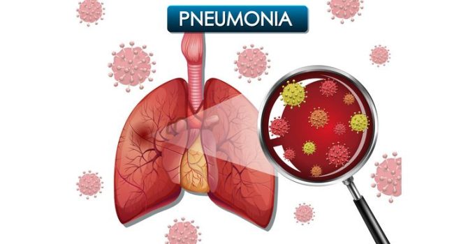 Pneumonia: Musuh Tak Terlihat yang Mengancam Paru-Paru Kita