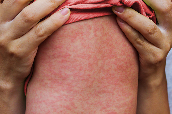 Penyakit Campak Menular